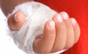 Волдырь от ожога что делать в домашних