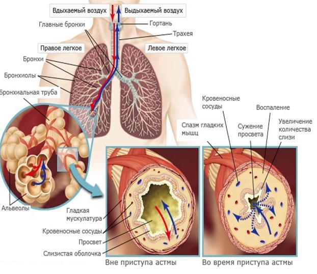 Что происходит при бронхите
