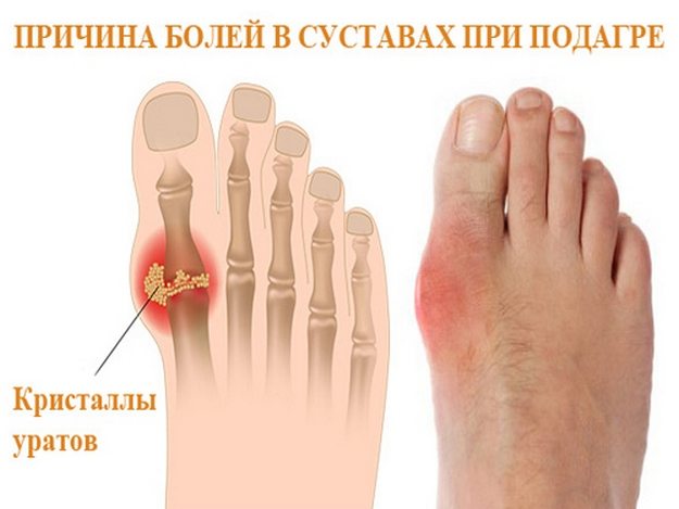 Подагра пальцев ног Подагра