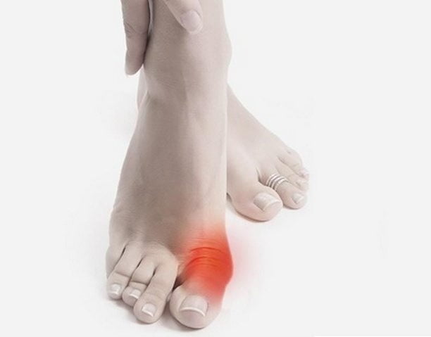 Боль в пальце ноги при подагре Подагра большого пальца ноги