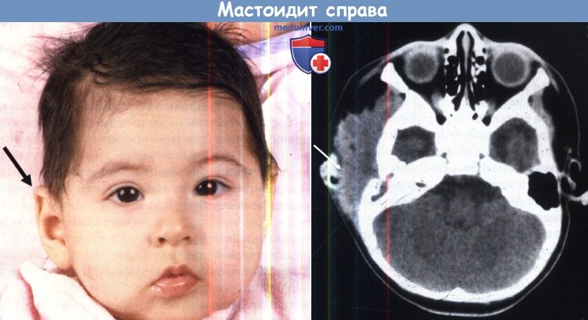 Мастоидит справа