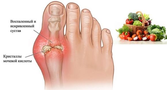 Нога при подагре