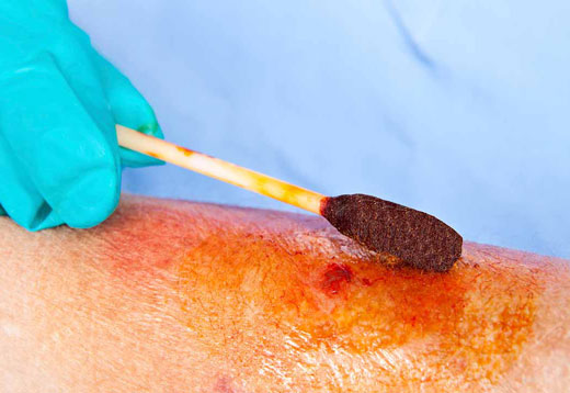 обработка ожога на руке йодом