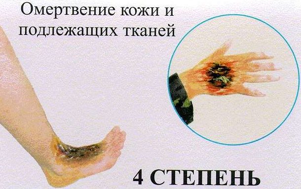 4 степени ожог