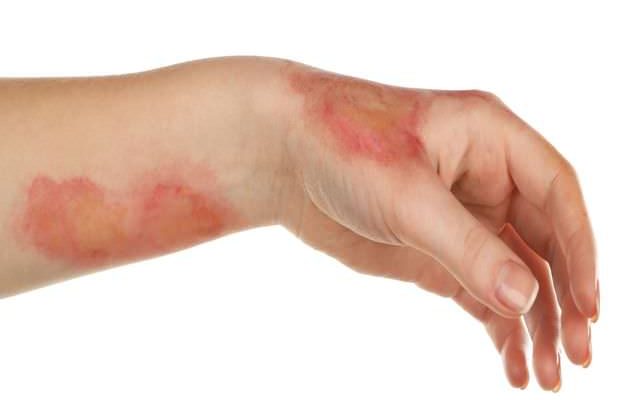 Как лечить ожог с гнойничками