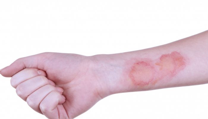 Как лечить ожог с гнойничками