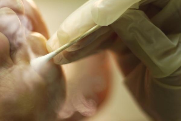 На месте ожога жидким азотом