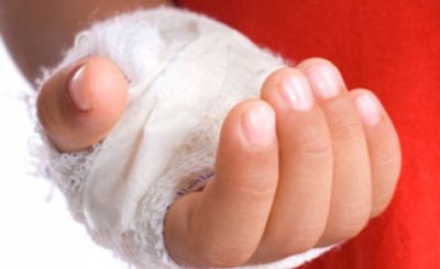 Ожог волдырь лопнул что делать