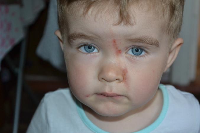 Легкий ожог на лице Легкий ожог на лице