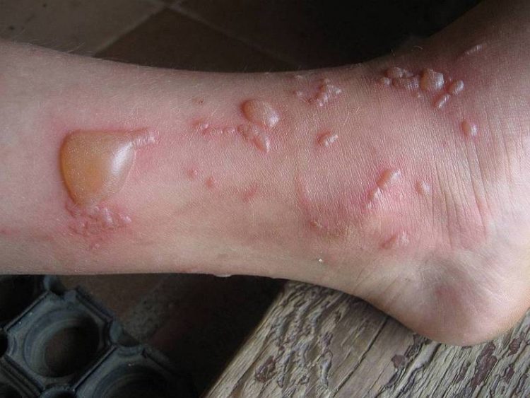 Ожог чем обрабатывать вскрытые волдыри