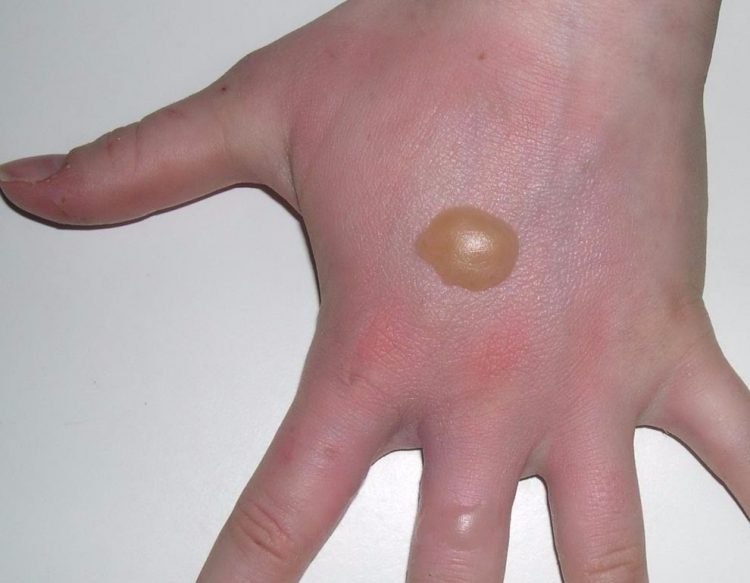 Ожог чем обрабатывать вскрытые волдыри