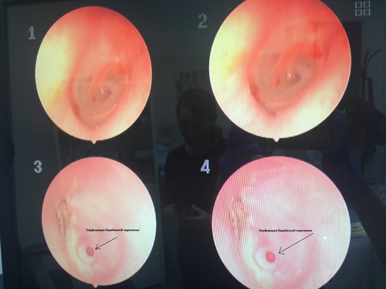 Перфорация перепонки