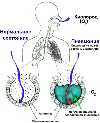 Пневмония. Схема лечения у взрослого, антибиотики, народные средства, лекарства