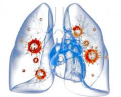 Лечение пневмонии у больных сахарным диабетом Лечение пневмонии у больных сахарным диабетом thumbnail