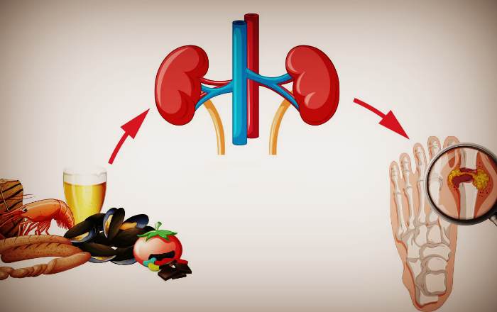 Причины возникновения подагры