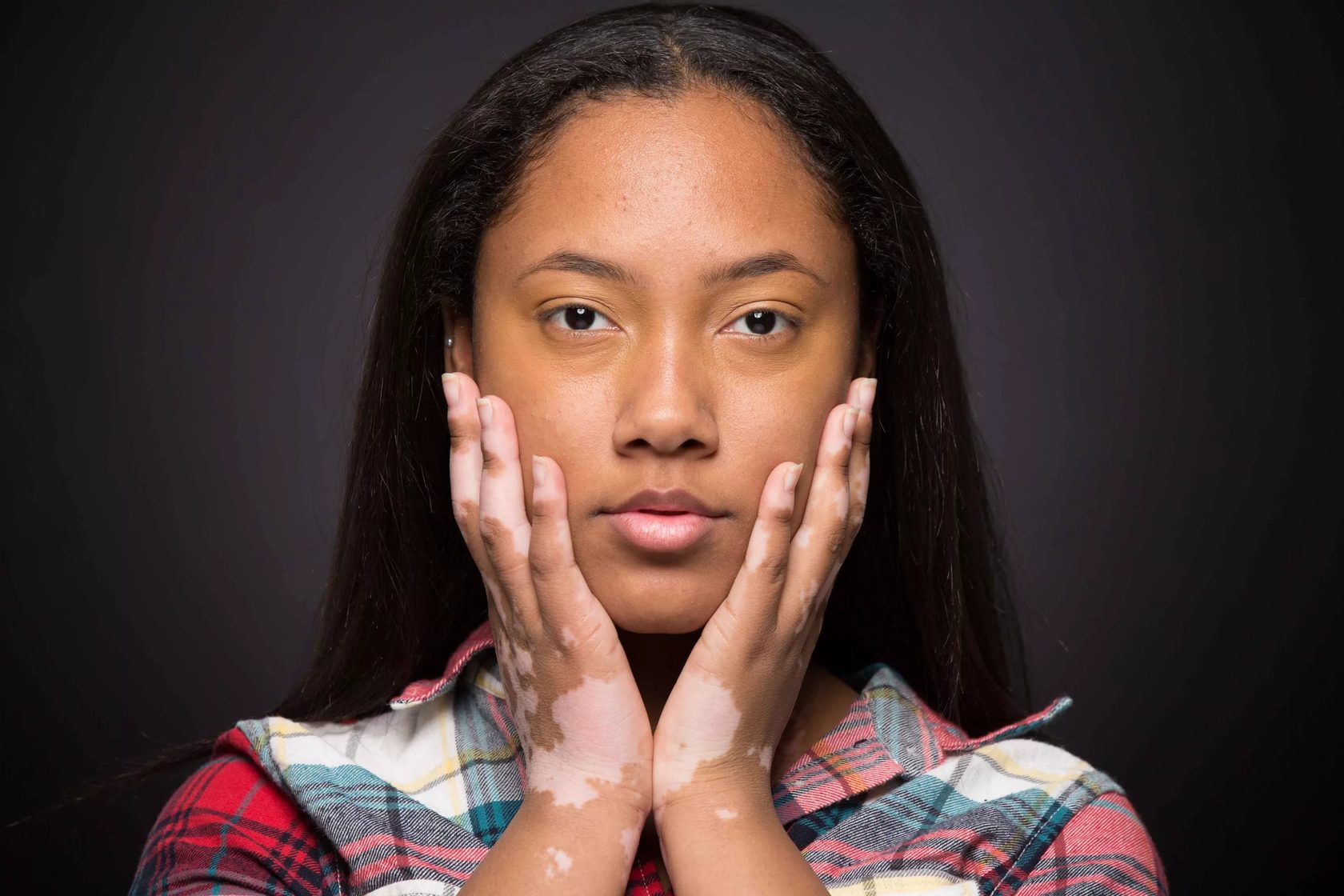 Девушка с витилиго