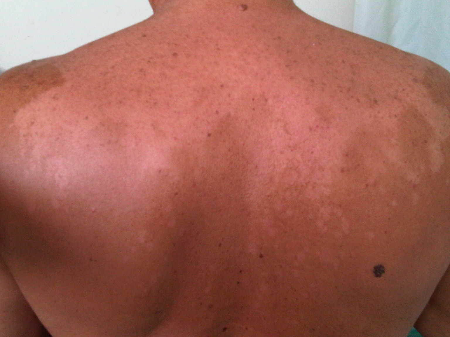 Отрубевидный лишай