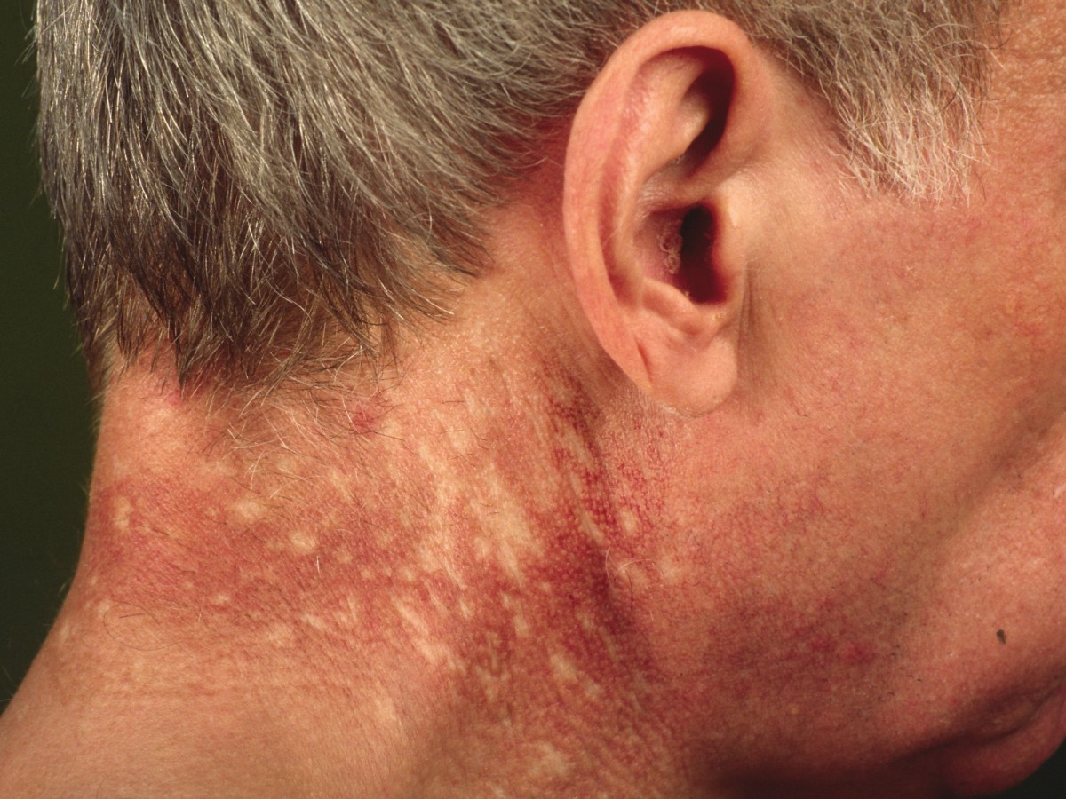 Пойкилодермия Сиватта