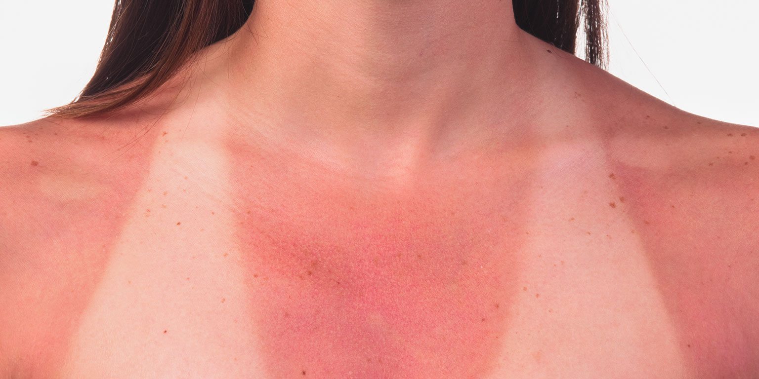 Солнечный ожог первой степени