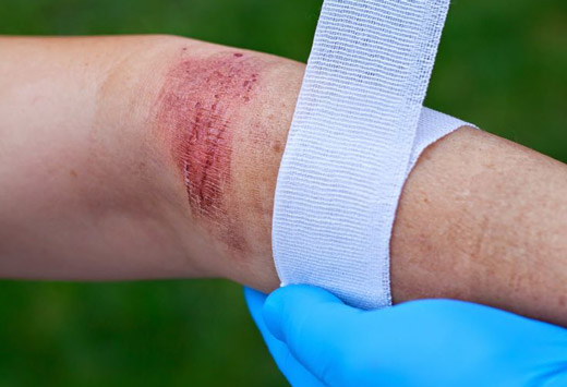 тканевая повязка на ожог