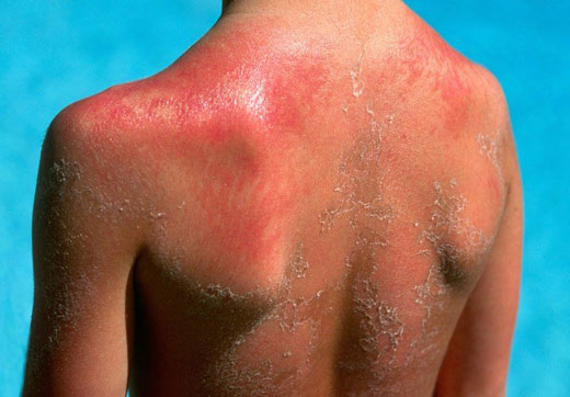 Ожог на спине