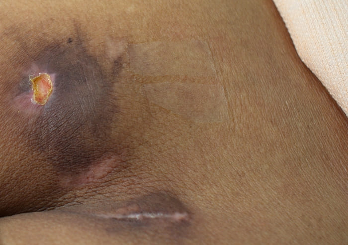 Как выглядят пролежни в картинках