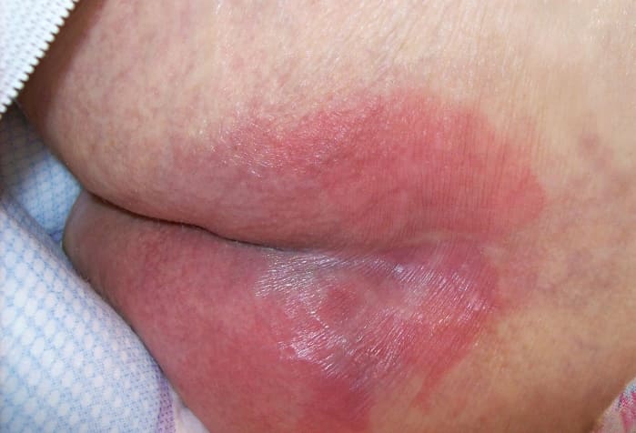 Как выглядят пролежни в картинках