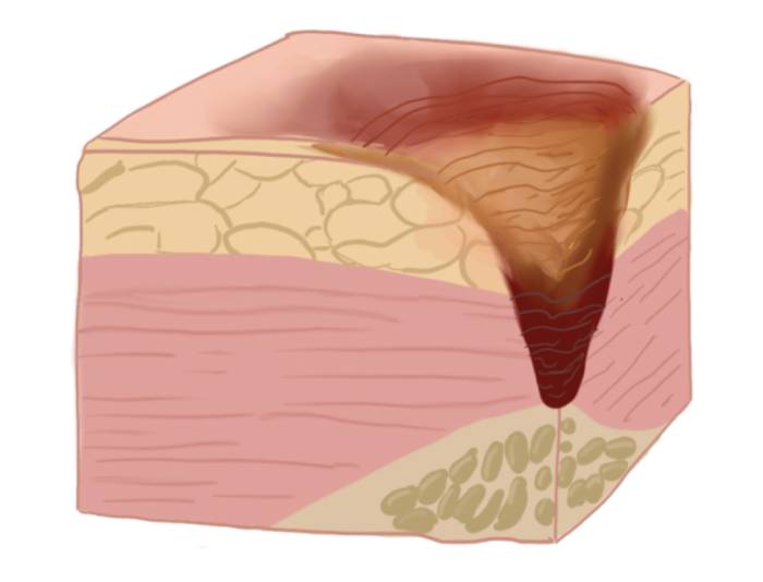 Пролежни: лечение и обработка в домашних условиях
