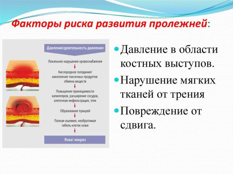 Пролежни: лечение и обработка в домашних условиях