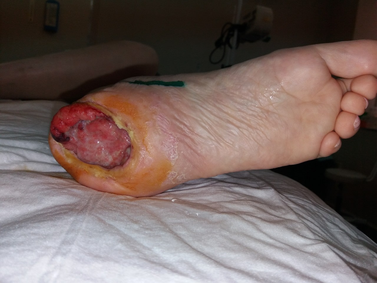 Пролежень пятки фото Пролежень пятки фото