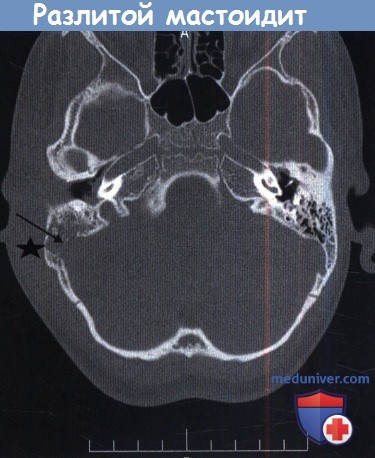 Разлитой мастоидит