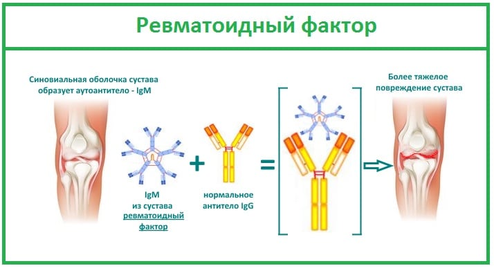 Остеоартроз коленного сустава это подагра