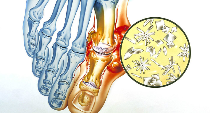 Лечение подагры в домашних условиях народными