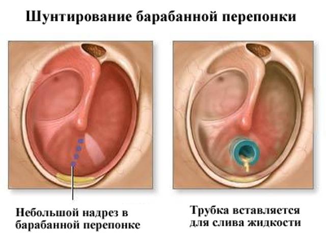 шунтирование