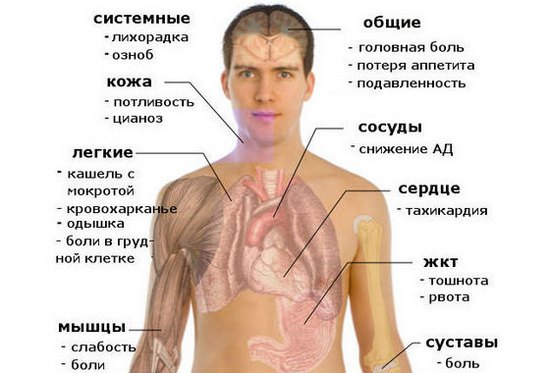 Симптомы пневмонии Симптомы пневмонии