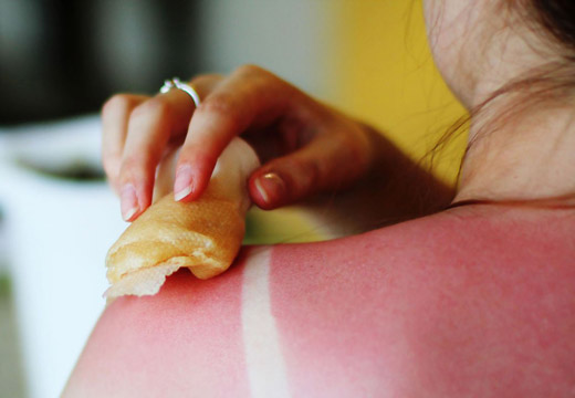 обработка ожога