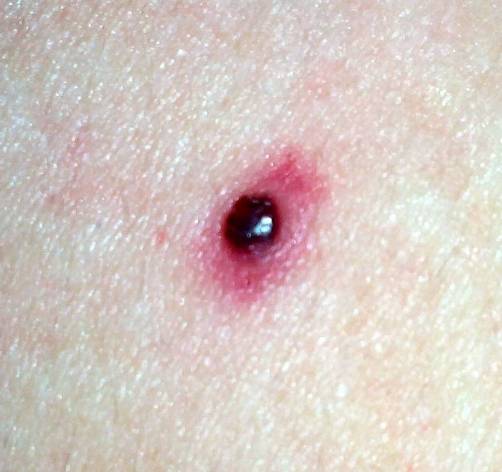 Из травмированной родинки может идти кровь. Из травмированной родинки может идти кровь.