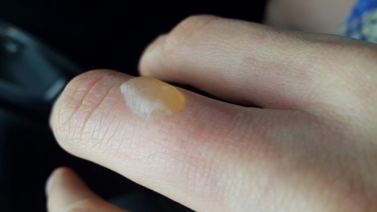 Ожог чем обрабатывать вскрытые волдыри