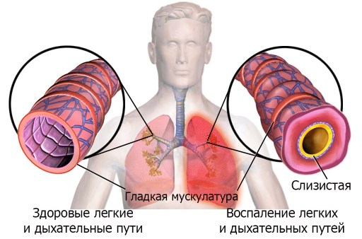 Затруднение дыхания обусловлено и сужением бронхов. Затруднение дыхания обусловлено и сужением бронхов.